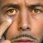 Man with yellowish eyes indicating possible liver issues.