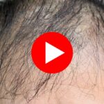 Close-up of male scalp with visible hair thinning.